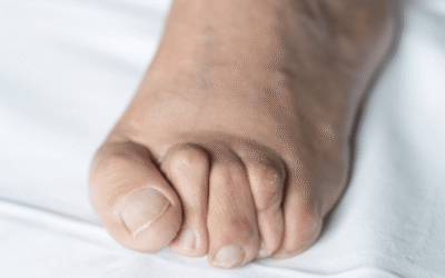 Understanding Hammertoes: Causes, Symptoms, and Treatment Options