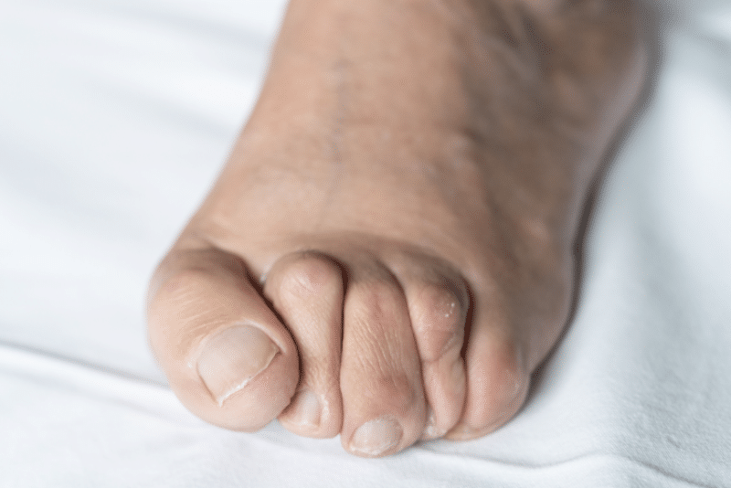 Hammertoe Specialist in Illinois Hammertoe Causes, Symptoms & Treatment